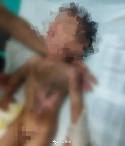 看好孩子!1岁宝宝打翻泡面全身大面积烫伤休闲区蓝鸢梦想 - Www.slyday.coM 看好孩子!1岁宝宝打翻泡面全身大面积烫伤休闲区蓝鸢梦想 - Www.slyday.coM