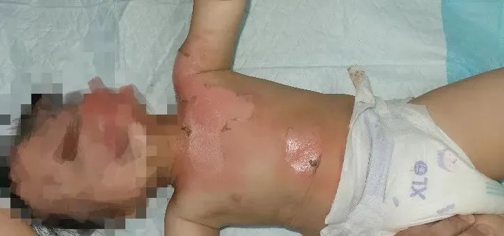 看着就好痛!2岁宝宝被泡面烫伤,家长一顿操作后……医生:严重错误休闲区蓝鸢梦想 - Www.slyday.coM 看着就好痛!2岁宝宝被泡面烫伤,家长一顿操作后……医生:严重错误休闲区蓝鸢梦想 - Www.slyday.coM