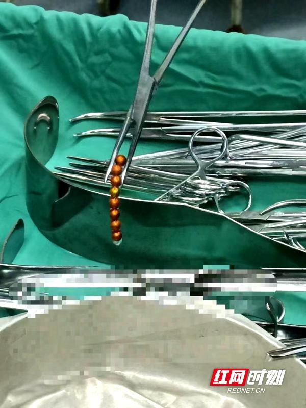 致命的磁力珠!7岁女孩误吞8颗致多处肠穿孔休闲区蓝鸢梦想 - Www.slyday.coM 致命的磁力珠!7岁女孩误吞8颗致多处肠穿孔休闲区蓝鸢梦想 - Www.slyday.coM