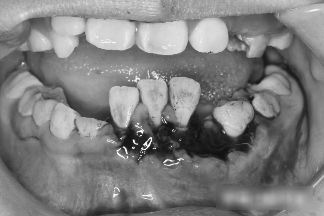 【遭遇】固原8岁女孩被电动车撞倒摔断牙齿!对方竟扬长而去…休闲区蓝鸢梦想 - Www.slyday.coM 【遭遇】固原8岁女孩被电动车撞倒摔断牙齿!对方竟扬长而去…休闲区蓝鸢梦想 - Www.slyday.coM