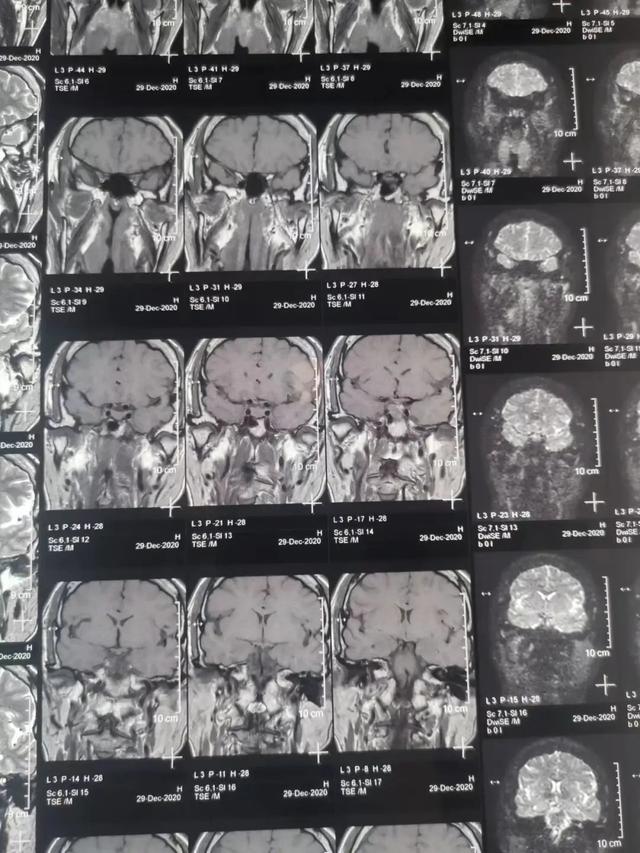 什么叫垂体微腺瘤 21c7-8422ca3ae03f7755090e1b17b3753218.jpg