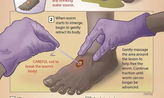 热搜第一的这个虫子,吓到很多人!曾让全球350万人痛苦不堪,没有特效药…...休闲区蓝鸢梦想 - Www.slyday.coM 热搜第一的这个虫子,吓到很多人!曾让全球350万人痛苦不堪,没有特效药…...休闲区蓝鸢梦想 - Www.slyday.coM