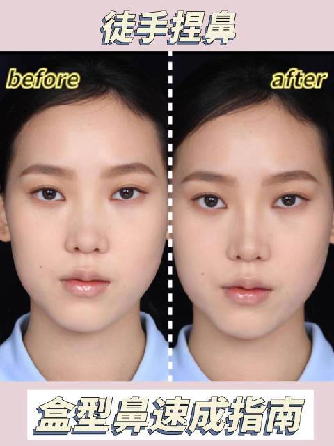捏鼻子鼻梁会变高吗？如何正确提高鼻梁？
