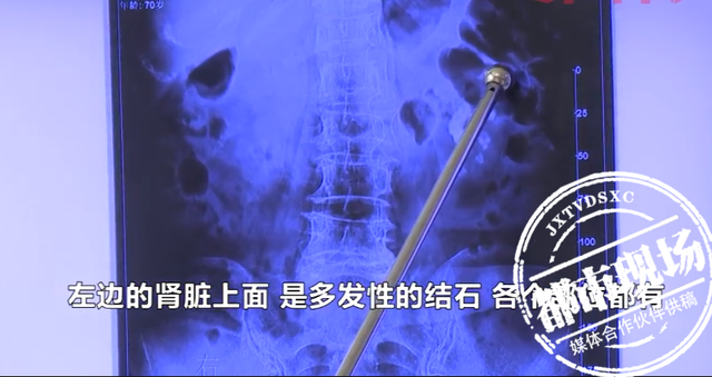 7旬女子患结石病10多年,自行吃药不痛就不去医院,左肾长满结石休闲区蓝鸢梦想 - Www.slyday.coM 7旬女子患结石病10多年,自行吃药不痛就不去医院,左肾长满结石休闲区蓝鸢梦想 - Www.slyday.coM