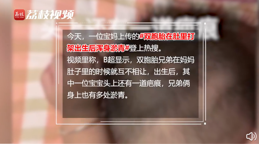 双胞胎在肚里打架出生后浑身淤青?产科医生发声休闲区蓝鸢梦想 - Www.slyday.coM 双胞胎在肚里打架出生后浑身淤青?产科医生发声休闲区蓝鸢梦想 - Www.slyday.coM