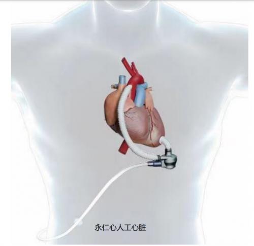 戴着人工心脏上脱口秀大会——王十七的充电人生休闲区蓝鸢梦想 - Www.slyday.coM 戴着人工心脏上脱口秀大会——王十七的充电人生休闲区蓝鸢梦想 - Www.slyday.coM