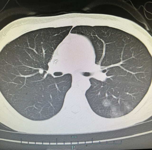 心疼!杭州24岁姑娘10年5次癌症,165厘米的她,体重只有66斤……休闲区蓝鸢梦想 - Www.slyday.coM 心疼!杭州24岁姑娘10年5次癌症,165厘米的她,体重只有66斤……休闲区蓝鸢梦想 - Www.slyday.coM