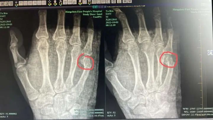 爸爸辅导作业一通怒吼,一拳把自己打骨折……住院时一句话让人心疼休闲区蓝鸢梦想 - Www.slyday.coM 爸爸辅导作业一通怒吼,一拳把自己打骨折……住院时一句话让人心疼休闲区蓝鸢梦想 - Www.slyday.coM