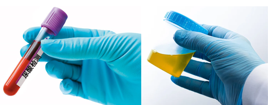 体检发现尿酸高,就是痛风?注意!这些因素可能会影响尿酸的检测结果休闲区蓝鸢梦想 - Www.slyday.coM 体检发现尿酸高,就是痛风?注意!这些因素可能会影响尿酸的检测结果休闲区蓝鸢梦想 - Www.slyday.coM