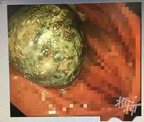 “再也不敢这么吃了…”浙江女子7个柿子下肚,长出巨型胃结石休闲区蓝鸢梦想 - Www.slyday.coM “再也不敢这么吃了…”浙江女子7个柿子下肚,长出巨型胃结石休闲区蓝鸢梦想 - Www.slyday.coM