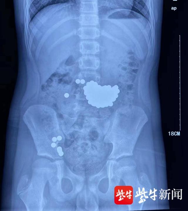 险!10岁男孩吞下近百颗钢珠,医生胃镜取出休闲区蓝鸢梦想 - Www.slyday.coM 险!10岁男孩吞下近百颗钢珠,医生胃镜取出休闲区蓝鸢梦想 - Www.slyday.coM