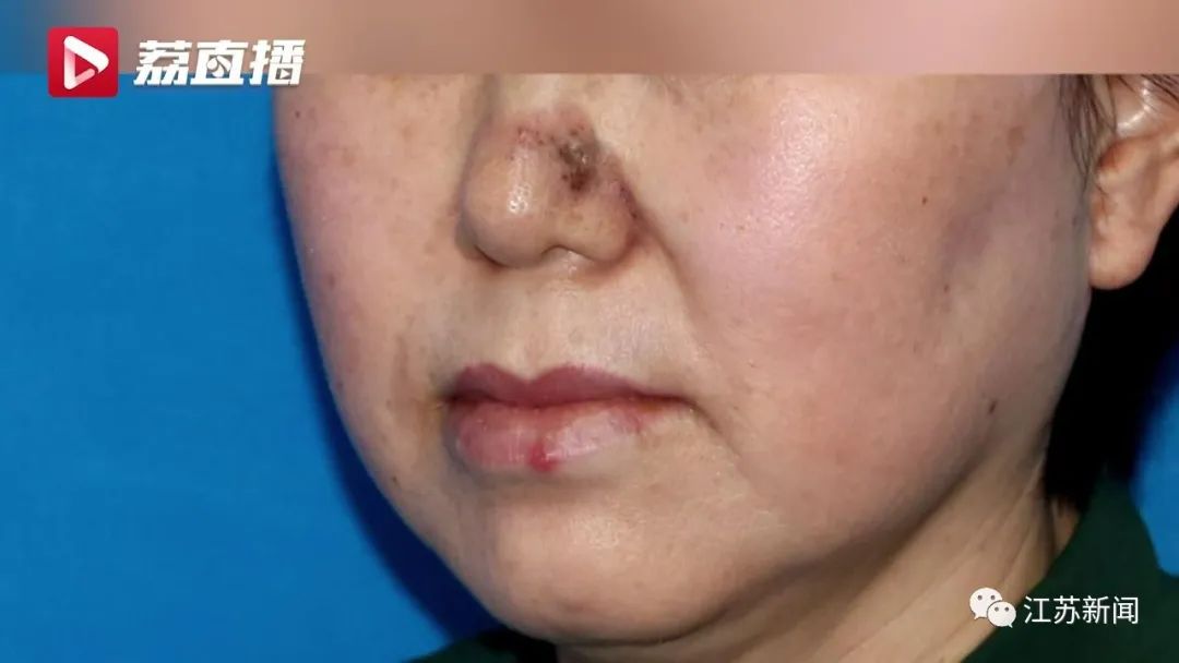 女子鼻子长疙瘩以为是黑头,医生一眼看出不对劲:是癌!休闲区蓝鸢梦想 - Www.slyday.coM 女子鼻子长疙瘩以为是黑头,医生一眼看出不对劲:是癌!休闲区蓝鸢梦想 - Www.slyday.coM