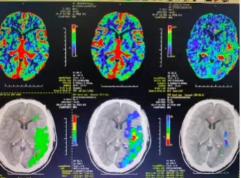 脑卒中防治一体化、全生命周期救治,“十院模式”是怎么做到的?休闲区蓝鸢梦想 - Www.slyday.coM 脑卒中防治一体化、全生命周期救治,“十院模式”是怎么做到的?休闲区蓝鸢梦想 - Www.slyday.coM