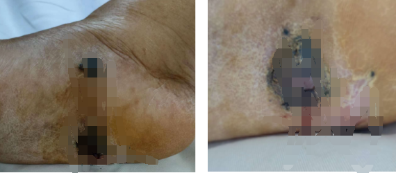 男子查出恶性肿瘤,竟与3年前的一次意外有……这种情况必须马上就医休闲区蓝鸢梦想 - Www.slyday.coM 男子查出恶性肿瘤,竟与3年前的一次意外有……这种情况必须马上就医休闲区蓝鸢梦想 - Www.slyday.coM