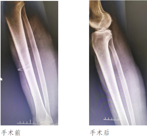 皮肤里长出新“骨”头 医生称这种情况很罕见休闲区蓝鸢梦想 - Www.slyday.coM 皮肤里长出新“骨”头 医生称这种情况很罕见休闲区蓝鸢梦想 - Www.slyday.coM