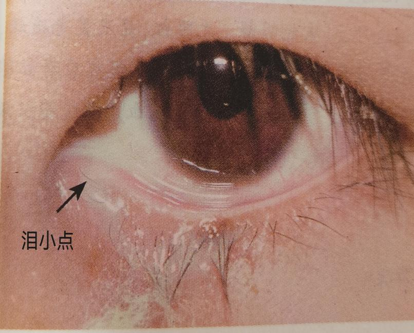 科普 中老年人流泪的秘密|眼科|中医|手术_新浪新闻
