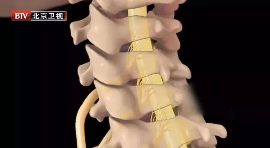 22岁女子按摩后大面积脑梗!这3个不经意的习惯或是“背后推手”!补充3种营养,帮你护血管休闲区蓝鸢梦想 - Www.slyday.coM 22岁女子按摩后大面积脑梗!这3个不经意的习惯或是“背后推手”!补充3种营养,帮你护血管休闲区蓝鸢梦想 - Www.slyday.coM