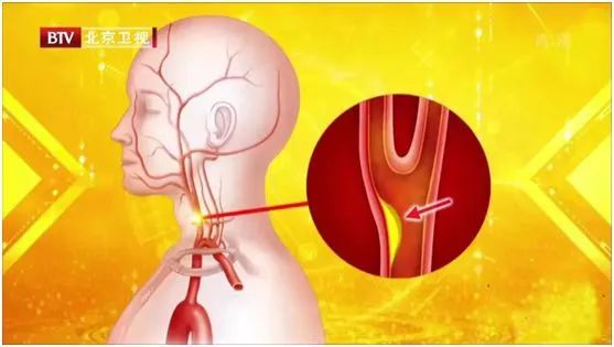 22岁女子按摩后大面积脑梗!这3个不经意的习惯或是“背后推手”!补充3种营养,帮你护血管休闲区蓝鸢梦想 - Www.slyday.coM 22岁女子按摩后大面积脑梗!这3个不经意的习惯或是“背后推手”!补充3种营养,帮你护血管休闲区蓝鸢梦想 - Www.slyday.coM