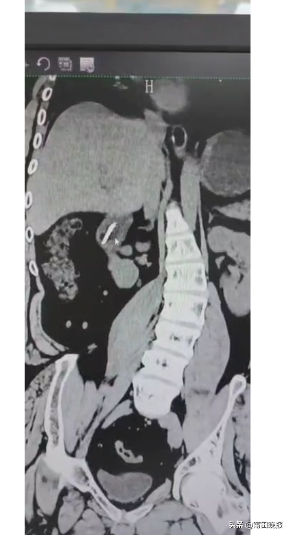惊险!一男子误吞18厘米长牙刷,莆田学院附属医院医生妙手解危休闲区蓝鸢梦想 - Www.slyday.coM 惊险!一男子误吞18厘米长牙刷,莆田学院附属医院医生妙手解危休闲区蓝鸢梦想 - Www.slyday.coM