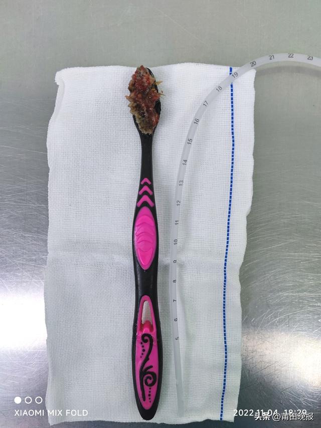 惊险!一男子误吞18厘米长牙刷,莆田学院附属医院医生妙手解危休闲区蓝鸢梦想 - Www.slyday.coM 惊险!一男子误吞18厘米长牙刷,莆田学院附属医院医生妙手解危休闲区蓝鸢梦想 - Www.slyday.coM