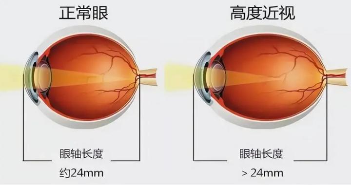 中国人视力下降元凶 保护孩子眼睛关键方法