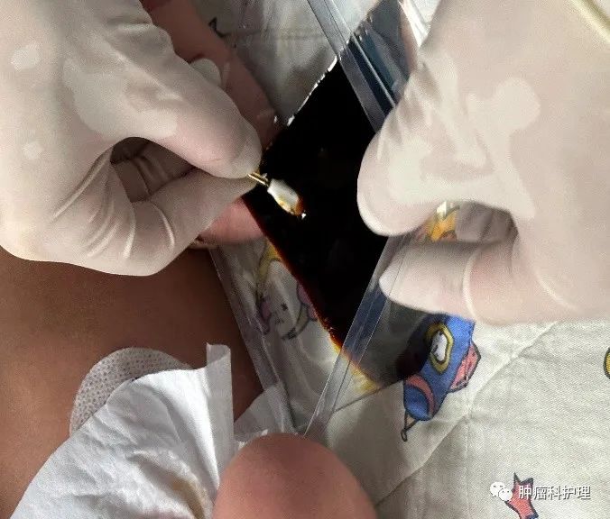 速看(picc管肝素帽)picc连接肝素帽,患儿肝素帽和PICC旋的过紧、拧不开时,你是怎么办的?, 速看(picc管肝素帽)picc连接肝素帽,患儿肝素帽和PICC旋的过紧、拧不开时,你是怎么办的?,