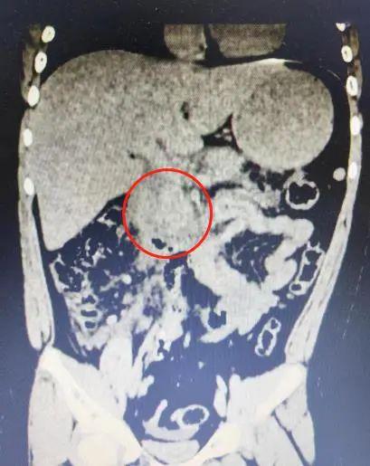 寒假里嗨吃零食,长沙体重110斤的12岁男孩患上此病休闲区蓝鸢梦想 - Www.slyday.coM 寒假里嗨吃零食,长沙体重110斤的12岁男孩患上此病休闲区蓝鸢梦想 - Www.slyday.coM