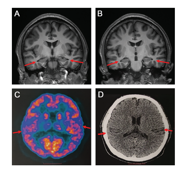 19岁患者患阿尔兹海默症,研究参与者:一度不敢相信检查结果休闲区蓝鸢梦想 - Www.slyday.coM 19岁患者患阿尔兹海默症,研究参与者:一度不敢相信检查结果休闲区蓝鸢梦想 - Www.slyday.coM