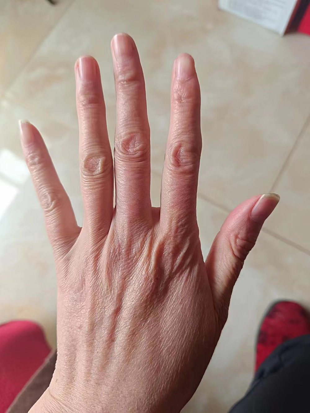 从小时候起,笑笑的手就比常人要大要长。