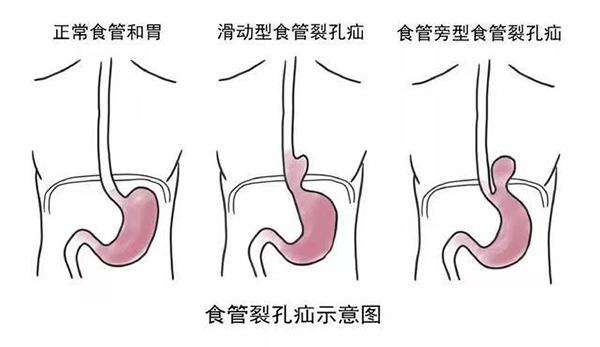 食管裂孔疝示意圖