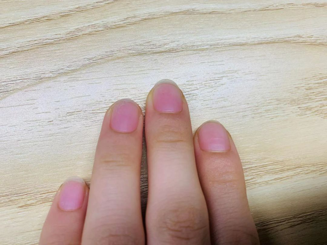 指甲白点、竖纹、月牙代表身体不健康？什么样的指甲是疾病的信号(竖纹)