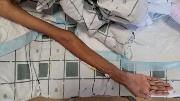 馬凡綜合徵患者的四肢情況。微信公眾號@廣東省中醫院 圖