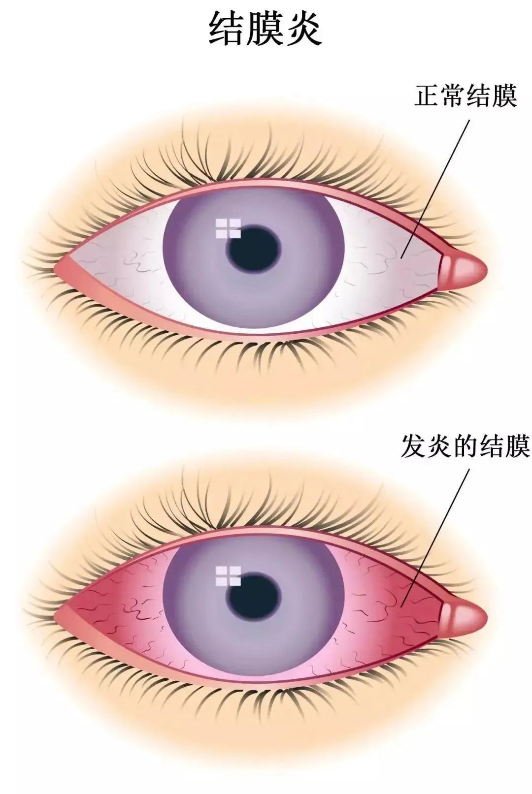 眼肌麻痹怎么治疗最快（痛性眼肌麻痹的出现，多与这些因素有关，得积极治疗） | 说明书网