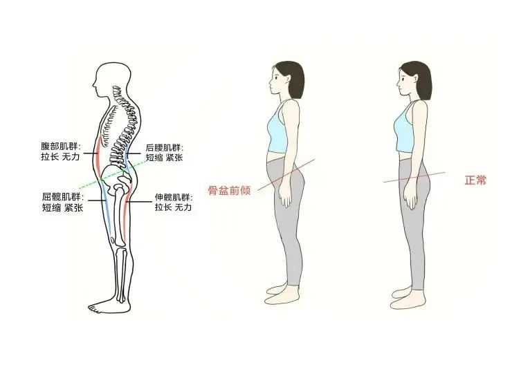 怎么趴着不会骨盆前倾 d815-b8cc57df148d4dca42f6c6c1e636c9b8.jpg