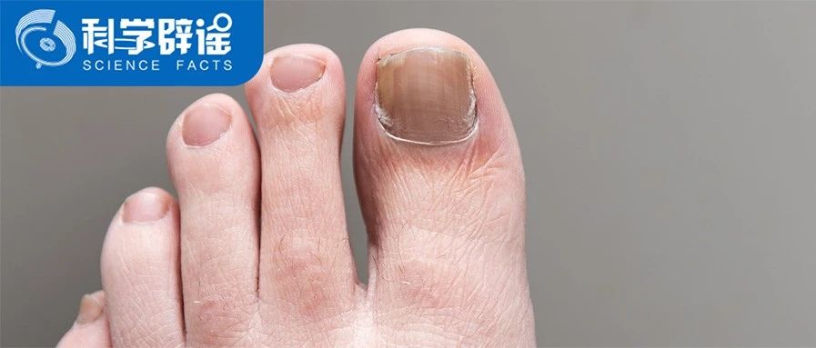 灰指甲盐酸特比萘芬片能治好吗 甲钴胺片对颈椎病有效吗