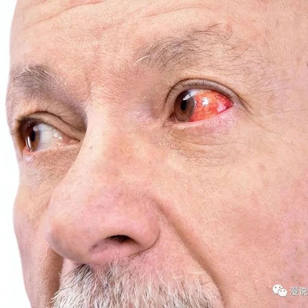 脸上为什么会有红血丝了？