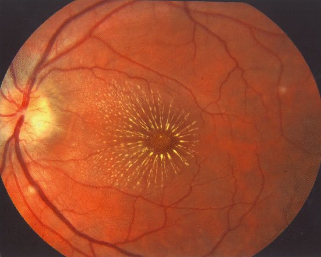 弓形虫病引起的视网膜脉络膜炎是什么样的？ - 知乎