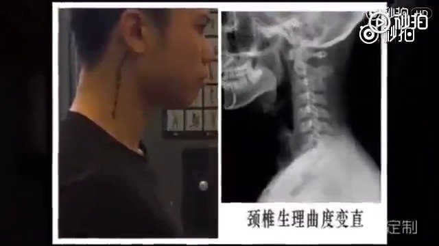 长期操劳的你颈椎还好吗？教你矫正颈椎曲度变直