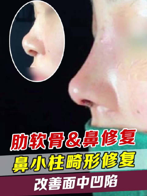 分享一个鼻尖畸形修复案例