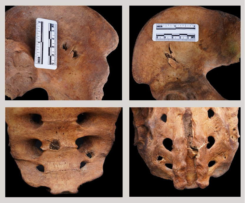 烈士遺骸上彈孔清晰可見