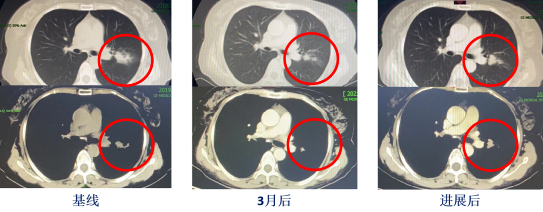 妙用三靶治疗，精准狙击奥希替尼耐药继发BRAF突变