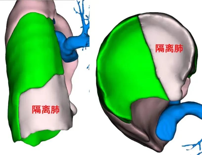 小伙肺发育畸形，专家手术用上了“地理学”