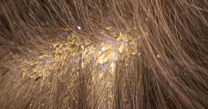 你的头皮上也有“黄色小颗粒”吗？这个小细节可能影响你的发量！