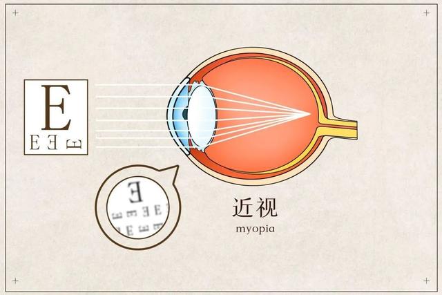 眼睛近视多少度算高度,眼睛近视多少度算高度近视?