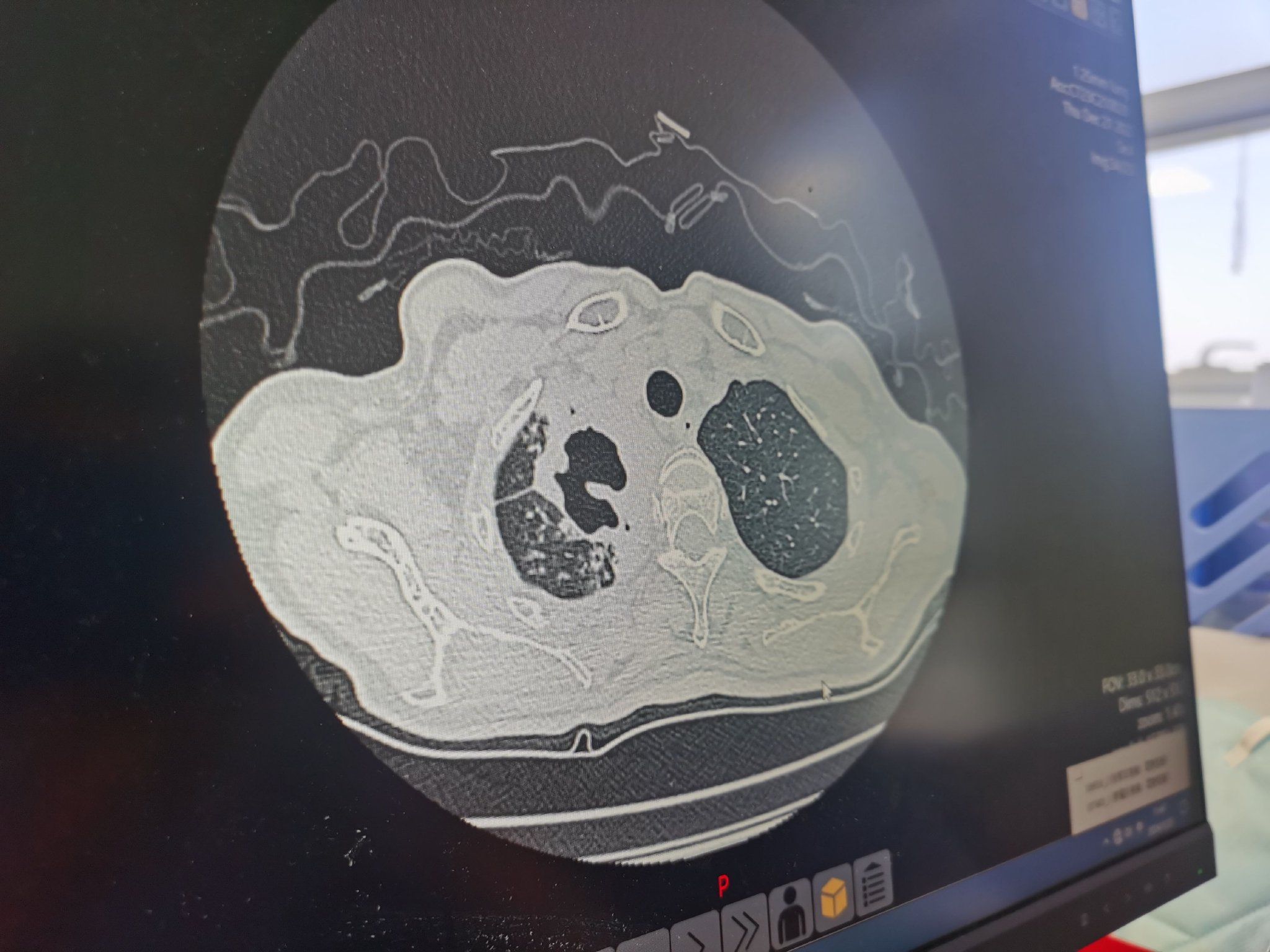 北京胸科醫院，一位肺結核患者的胸片，左右肺迥異，右肺出現空洞和病灶。新京報記者 戴軒 攝