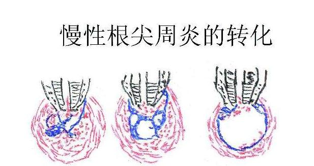 根尖周炎为何会临幸你？