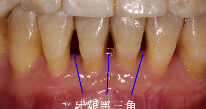 牙齿萎缩出现黑三角-4种方式改善它！