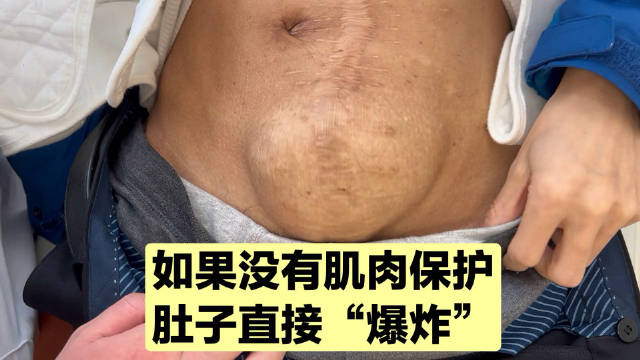 肚子缺乏肌肉保护，兜不住内脏，鼓起来一个大包，必须修补缺损！