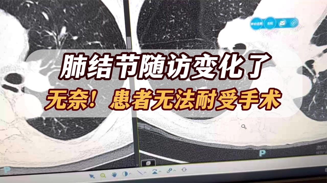 肺结节确实变大了，可惜身体承受不了手术！医生：有2条路能选