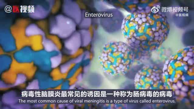 病毒性脑膜炎 脑膜炎（meningitis）系指软脑膜的弥漫性炎症性改变